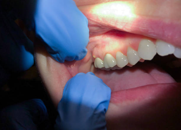Best Emergency Broken Tooth Repair in Minden, NE