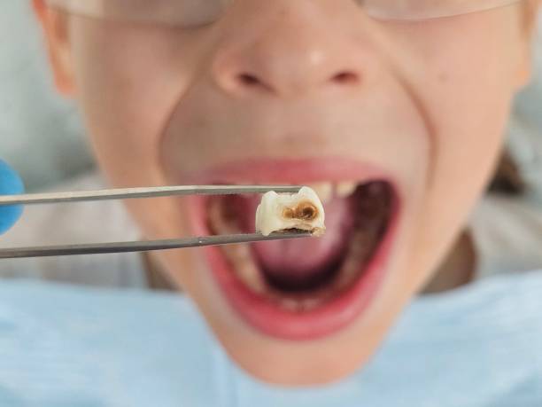 Best Emergency Treatment for Toothache in Minden, NE